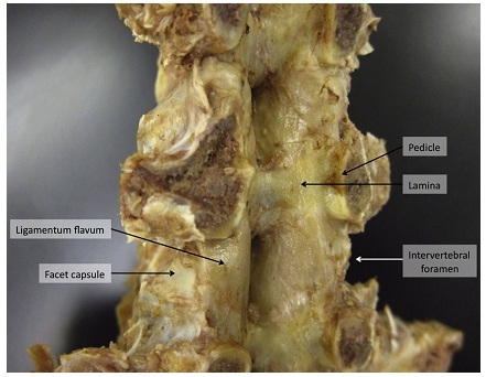 腰椎黄韧带与椎板、椎间孔关系解剖研究