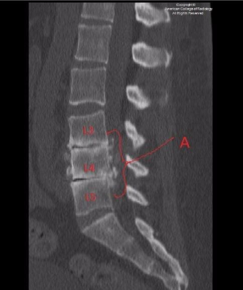 病例挑战:椎旁硬膜外钙化究竟是什么?